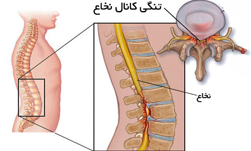تنگی کانال نخاع