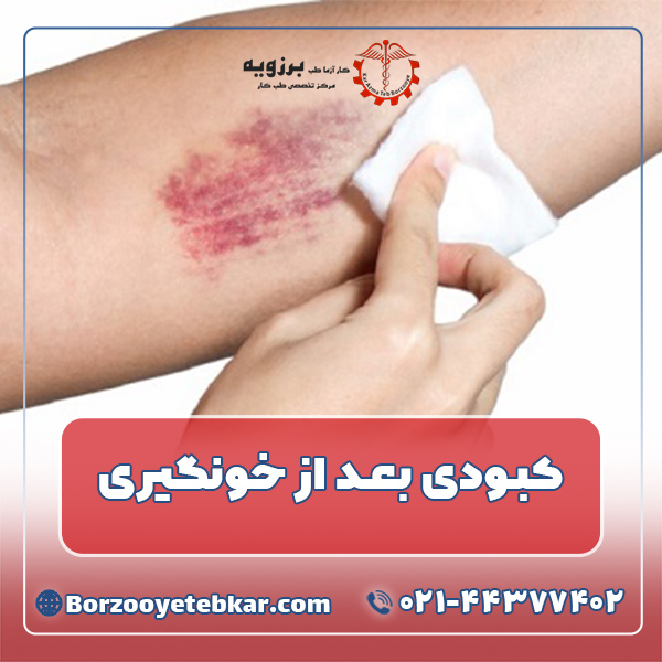 کبودی بعد از خونگیری