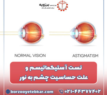 تست آستیگماتیسم و علت حساسیت چشم به نور