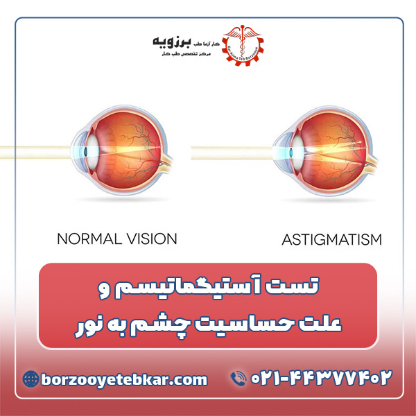 تست آستیگماتیسم و علت حساسیت چشم به نور