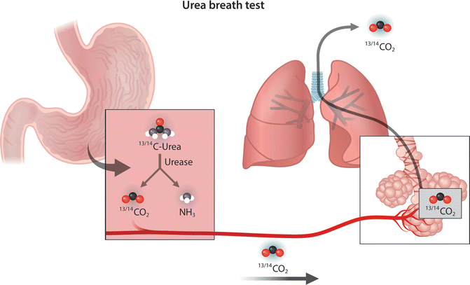 آزمایش تنفسی اوره یا UBT