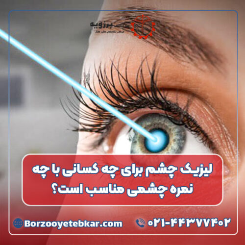 لیزیک چشم برای چه کسانی با چه نمره چشمی مناسب است؟ لیزیک چشم برای چه کسانی با چه نمره چشمی مناسب است؟